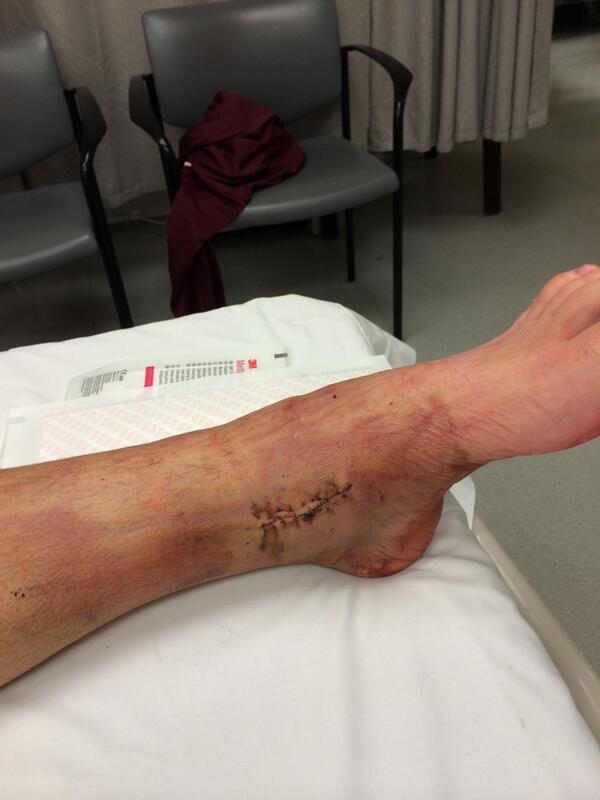 Ranta16's tweet photo. Ankle after surgery, old cast off new one on #4moreweeks http://t.co/DH0LCLIV2L