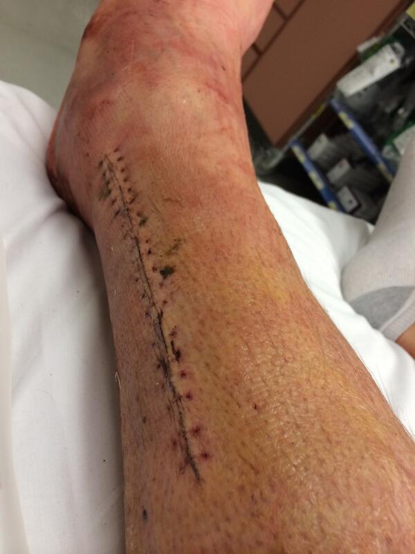 Ranta16's tweet photo. Ankle after surgery, old cast off new one on #4moreweeks http://t.co/DH0LCLIV2L