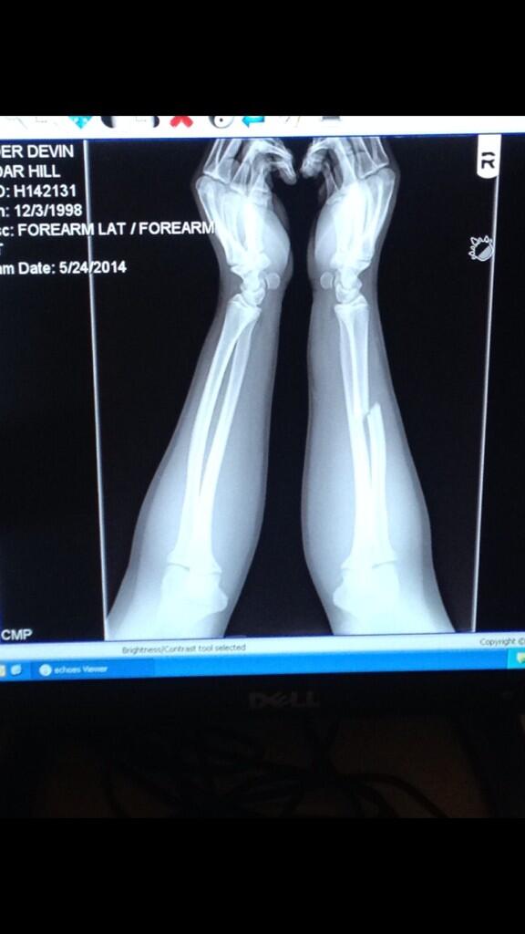 bradatc's tweet photo. @injurypics The joys of the Spring Football game. http://t.co/dEGFIE4I5k