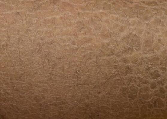 ихтиоз вульгарный ихтиоз. эпидермический ихтиоз. сухая кожа покрытая чешуйками. чешуя змеи. чешуя рептилий.