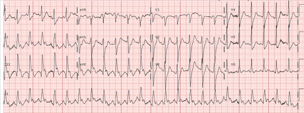 smithECGBlog's tweet image. Acute Cardiogenic Shock.  What is the Diagnosis? #FOAMed #ECG #CodeSTEMI hqmeded-ecg.blogspot.com/2014/05/acute-…