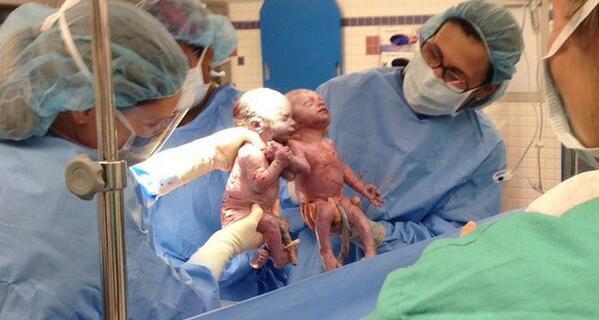 Nacen dos gemelas monoamnióticas agarradas de las manos, una imagen increíble que está dando la vuelta al mundo