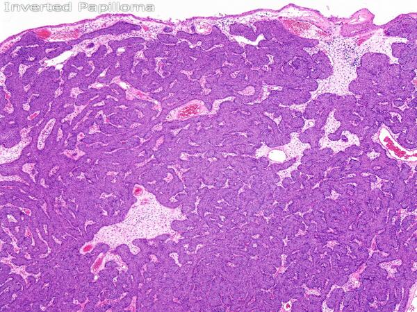 inverted papilloma of bladder histology reacții adverse ale febrei