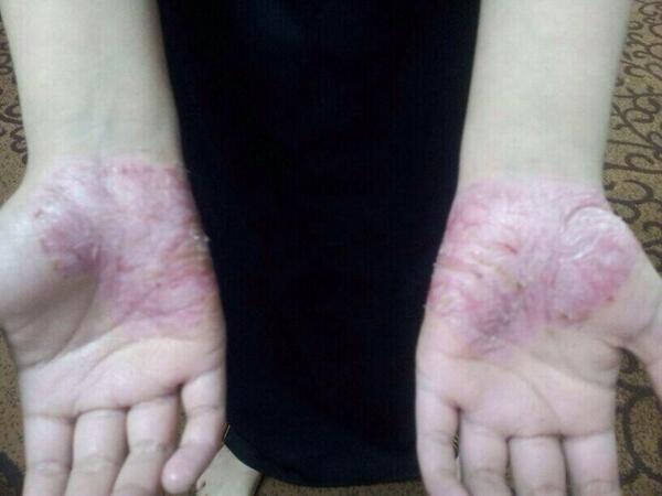 b444455555's tweet photo. هذه الصورة لنفس الطفله صدفيه في الأيادي  قبل العلاج http://t.co/6doZfx3KZA