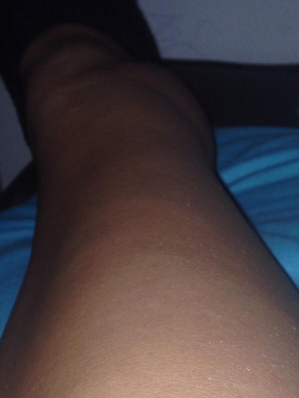 paydayshea17's tweet image. Anyone who has broken a bone. Is this the worst pain? I&apos;ve never broken anything. #ExplainItToMe