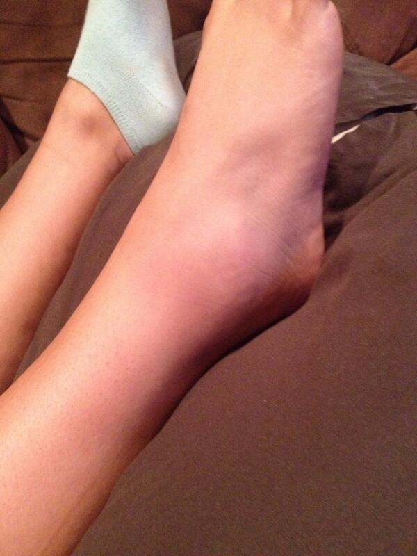 paydayshea17's tweet image. Anyone who has broken a bone. Is this the worst pain? I&apos;ve never broken anything. #ExplainItToMe