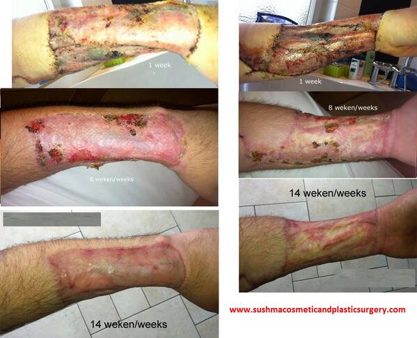 Penis before and after surgery