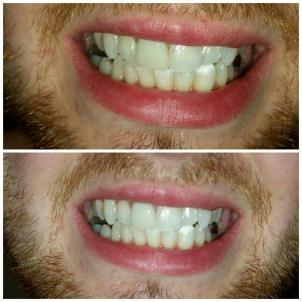 awsglasgow's tweet photo. Client results only 1 use😀!! #happyclient #teethwhitening #goodfeedback #allwhitesmiles #beforeandafter #whitening http://t.co/bO9Oee4MQ1