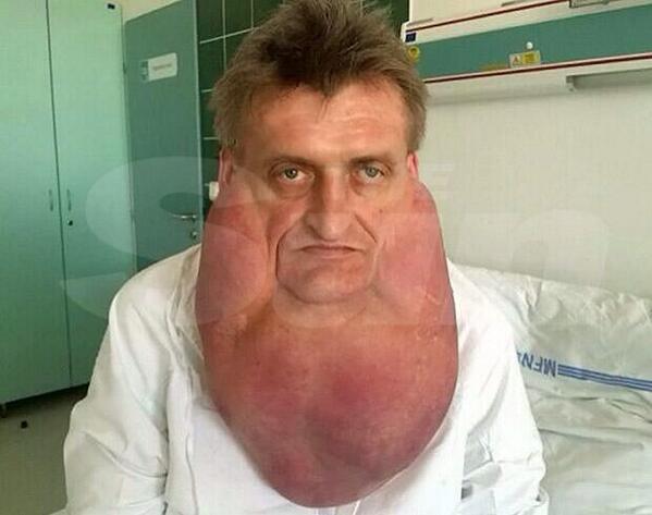 dapperlaughs's tweet photo. “@TheSunNewspaper man had a 13lb tumour removed from his neck" - This fellas got some cheek, take it on the chin son http://t.co/tFB17M6VAB