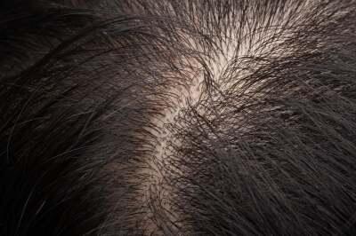 in4mnatn_health's tweet photo. Here are 30 remedies for #dandruff - herbs, home treatments, essential oils and supplements. http://t.co/NspScMjZeq http://t.co/FPUVD1B9ks