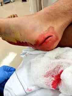 Sctitches's tweet image. Stepping on a tin can lid was painful