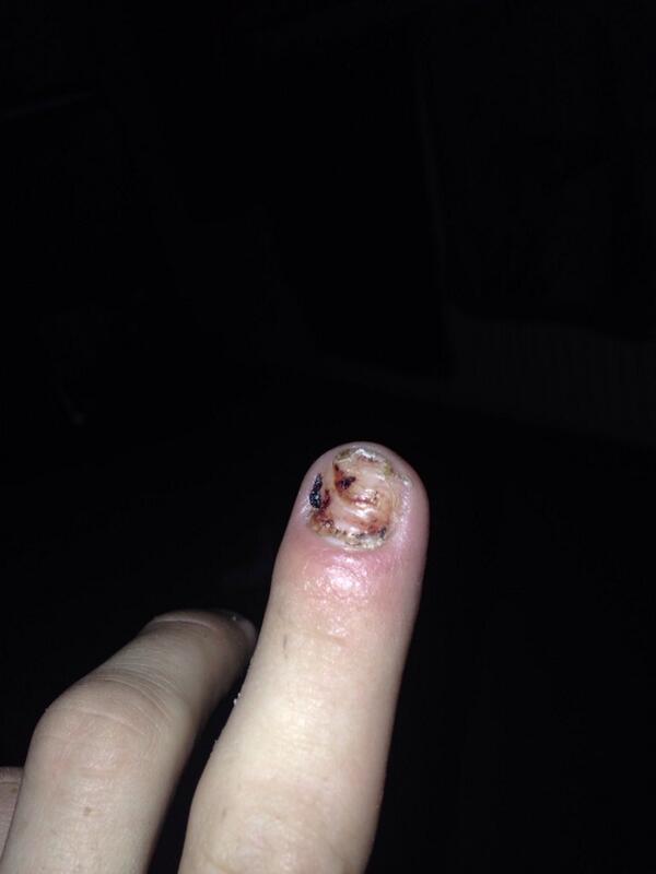 GarryPenman's tweet photo. @AaronCameron67 nails finally off http://t.co/eHtHqjZdLd