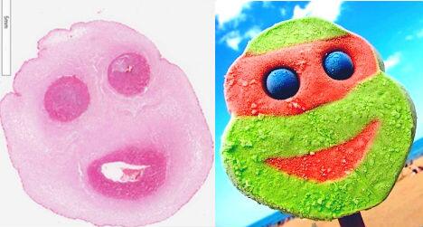 MonsterMedicine's tweet photo. The umbilical cord looks like a TMNT popsicle. That is all. http://t.co/t7fSUMsUAX