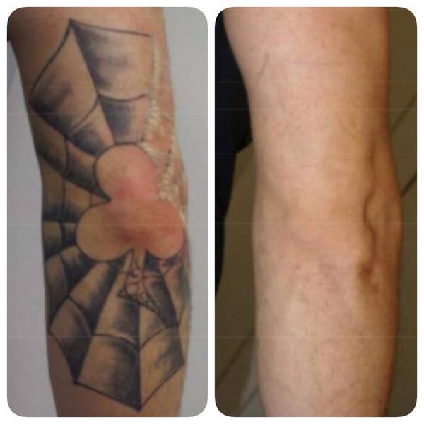 LaserAvantSpain's tweet photo. #TattooRemoval #tatuaje eliminado en 7 sesiones y sin efectos secundarios. http://t.co/h9zJAr0UXO