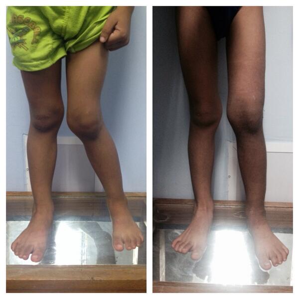 DPalacioParra's tweet photo. Genus valgo pos traumático. Osteotomia varizante supracondilea http://t.co/kmobFFGVJT