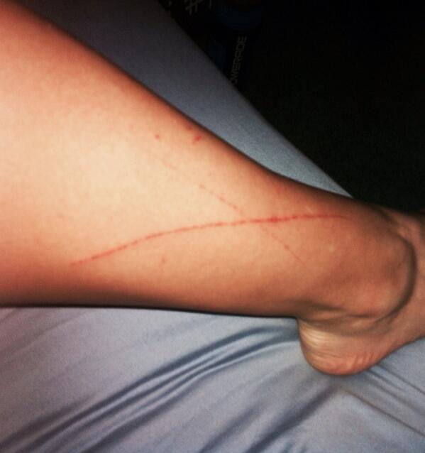djpturnup's tweet image. "X" marks the spot. #ouch #hikingproblems