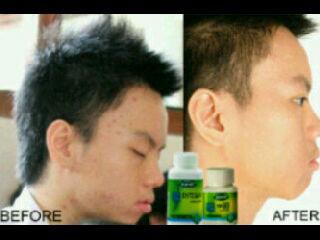 MaskerAlami_ID's tweet photo. Salah Satu Konsumen Kami Setelah Pemakaian Paket Pemutih Herbal. Mau juga? Invite Pin: 27ae580a  Hp 082217608421 #NOW http://t.co/tfm4cT4XiB