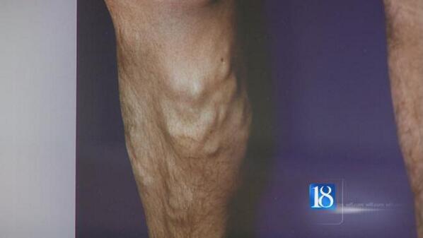 AndrewAltmanMD's tweet photo. They may seem only cosmetic, but doctors say it’s important to have #varicoseveins looked at. http://t.co/355cUdyZ66 http://t.co/fHQ5eFCiYI