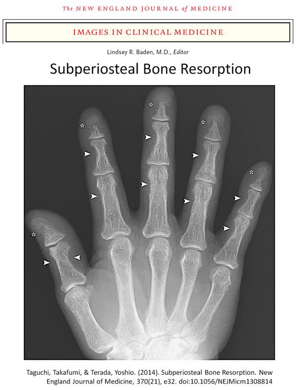 Остеопороз фаланг пальцев. Узелки гебердена и бушара. Анатомия дистальной фаланги кисти. Название фаланг пальцев рук. Пястные кости.