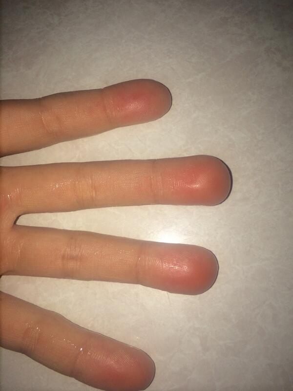 softemma4816's tweet photo. burns have my fingers looking like ET http://t.co/z4kAQZx8oB