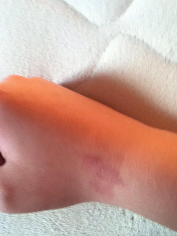 CWant3d's tweet image. I was bored so I stated biting on my hand