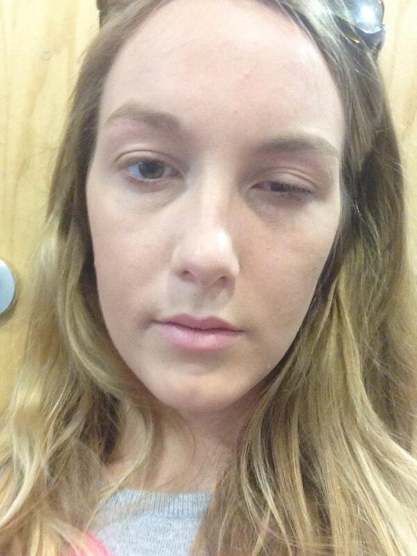 Did not enjoy having my eyelid flipped by the Dr. In A and E this morning. #notgotthatfridayfeeling