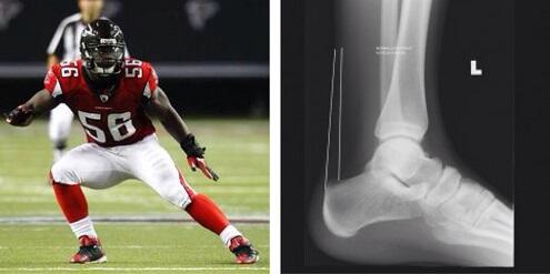 InsideInjuries's tweet image. #SeanWeatherspoon ruptured his Achilles tendon, and will miss the 2014 season.#injury #Falcons insideinjuries.com/sean-weathersp…