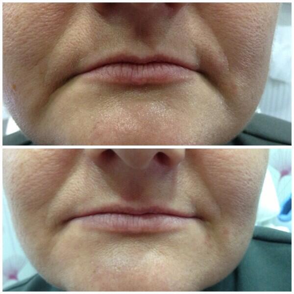 Precise_PMA's tweet image. Down-turned mouth can be effectively treated with Dermal Fillers. Treatments by a dentist. spabannockburn.co.uk