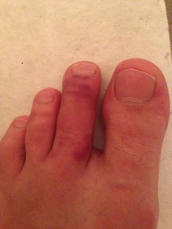 iamthetickler's tweet photo. My fuckin toes busted to shit, I tickled it too hard. How am I going to escape Braintree houses tonight?!?!?!! http://t.co/gCR6mBmdev