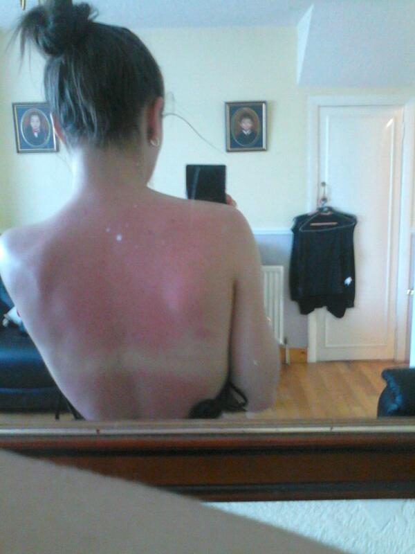 xxDebbiexox's tweet image. Burnt :-) #NeverBurn #Chuffed #GonnaBeTan