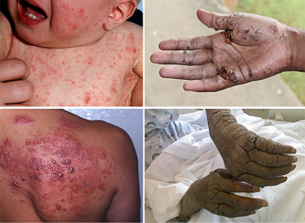 Illegal border hoppers now spreading diseases to Americans