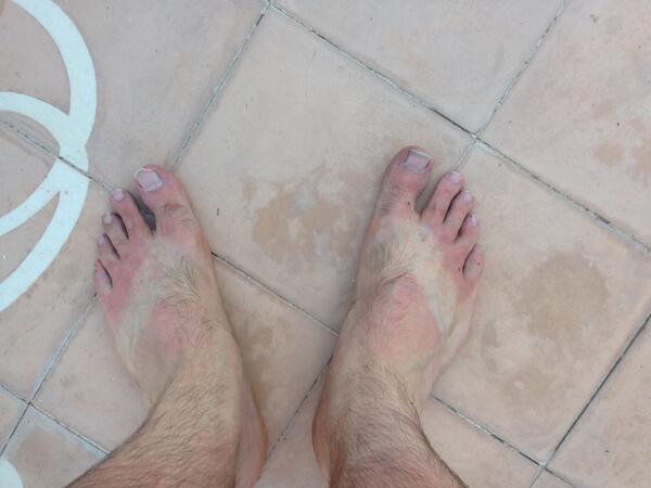 tompilk's tweet image. Guess I missed a spot... #SuncreamWoes #PilksInAfrica