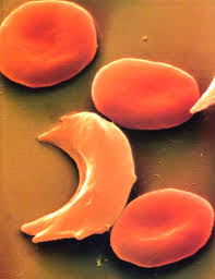 Shondrella's tweet photo. @SickletheCycle It's World Sickle Cell Day!Please show your support #sicklestrength #WSCD2014 http://t.co/MXNnPvHFOw
http://t.co/b645sNRlhH
