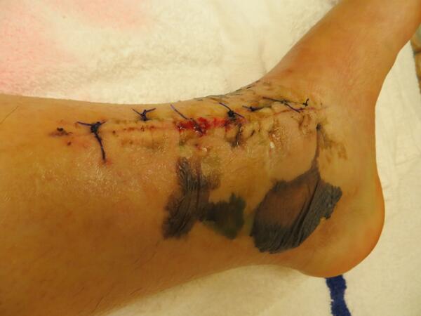 derbyprobs's tweet image. Rollerderby is a dangerous sport, kids. Sometimes you break a leg and make a big old mess. #fractureblisters #tibfib