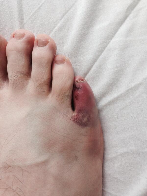 steel toe boot injuries