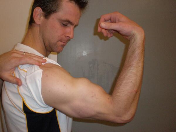 Rugby Onslaught On Twitter So That S What A Ruptured Bicep Looks Like Thanks Chris Paterson Http T Co Qte8cgrd35
