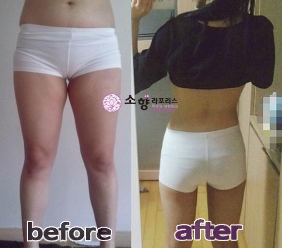#소향라포리스 #지방흡입 후기 2탄. 어마어마한 변화예요!  본격적인 #여름 이 시작되는데 ^^ 여러분도 ~?! #이벤트 중이니까 망설이지 마세요