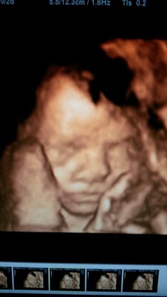 Pearl_baby_scan's tweet image. Gorgeous bubbas this evening #3dbabyscan #pregnancy 💙💗