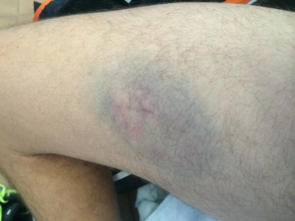 My leg belongs to <a href="/OswaldPhilipp/">Philipp Oswald</a>!!! Thx so much #tennispointbundesliga#neuvsaac #doubles #nomorequickhands