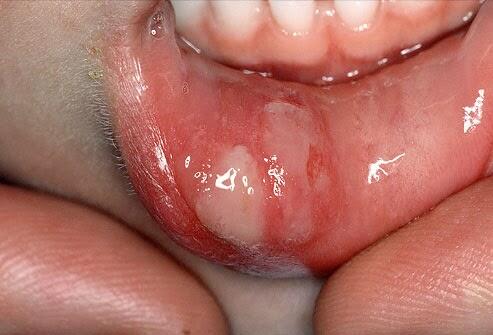 DENTISTwit's tweet photo. Stress menjadi faktor resiko timbulnya sariawan. https://t.co/1HwrFY9BCR