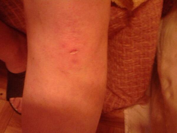 clippiespain's tweet image. New glasses couldn't prevent a fall.Fingers crossed the knee won't swell more! #coldtowel #feelstupid #whatelseawaits