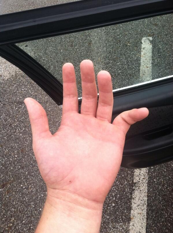 BradTschannen's tweet image. Great day at football today #dislocated