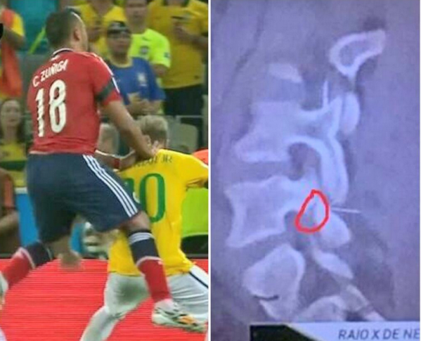 voetbalzonenl's tweet photo. Volgens berichten uit Brazilië had Neymar verlamd kunnen raken als hij zijn rugwervel iets hoger had gebroken. http://t.co/TFExfEF29L