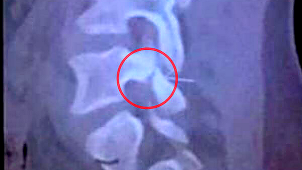 Schock-Diagnose! Röntgenbild zeigt Wirbelbruch Neymars >> focusonline.co/1ol7EPQ

#Neymar #WM2014 #BRACOL