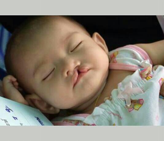 Pick_mii's tweet photo. [RT] ใครมีลูกหลานปากแหว่งเพดานโหว่ฝ่าตัดฟรีที่รพ.ยันฮีจ้า รีต่อเอาบุญจ้า 
รายละเอียดติดต่อรพ.ยันฮีเลย #HowtoPerfect http://t.co/8d5cqHhBIQ