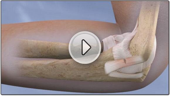 understandmed's tweet photo. #Orthopaedic customers your library has been upgraded with a new #UCLReconstruction animation https://t.co/GEzfaUgjoK http://t.co/w3KCXeuX1f