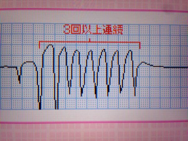 拍 心室 頻