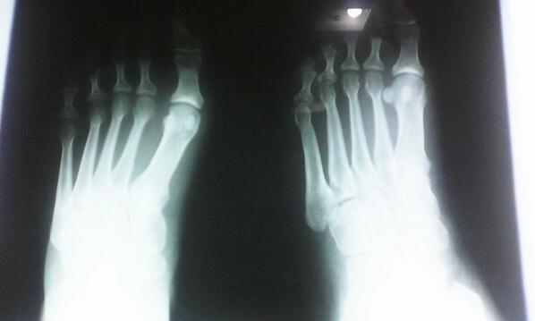 adalagui15's tweet photo. Awww amiga mira como estoy me fracture el dedi http://t.co/8qlRwwAwPU