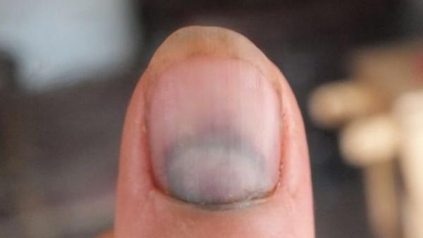 Kate Beavan On Twitter Note To Self Remove Thumb From Car