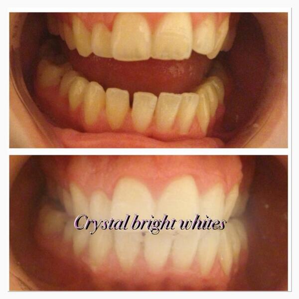 CrystalBrights's tweet photo. Lasor  teeth whitening £59 per person #teeth #white #summer #lasor http://t.co/NFhsifK6oQ